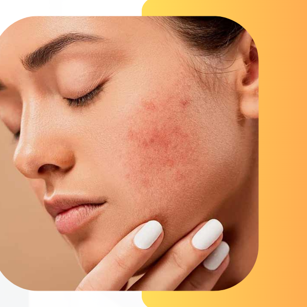 Acne and acne scar Treatments
