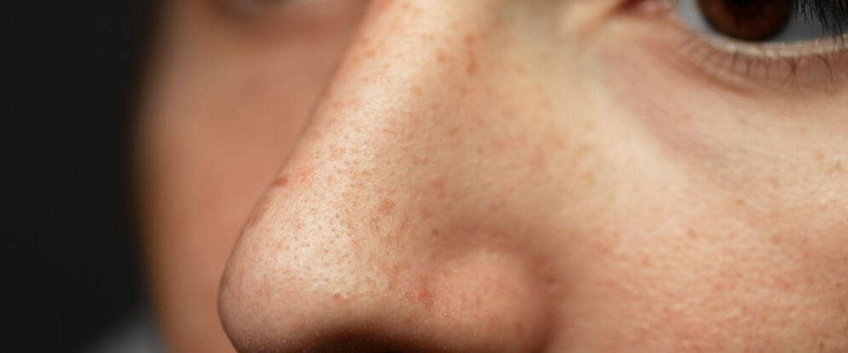 Read more about the article Pigmentation Correction Treatment