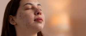 Read more about the article Acne & Acne Scar Treatments