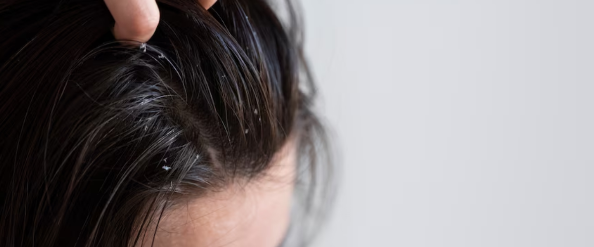 Read more about the article hair dandruff