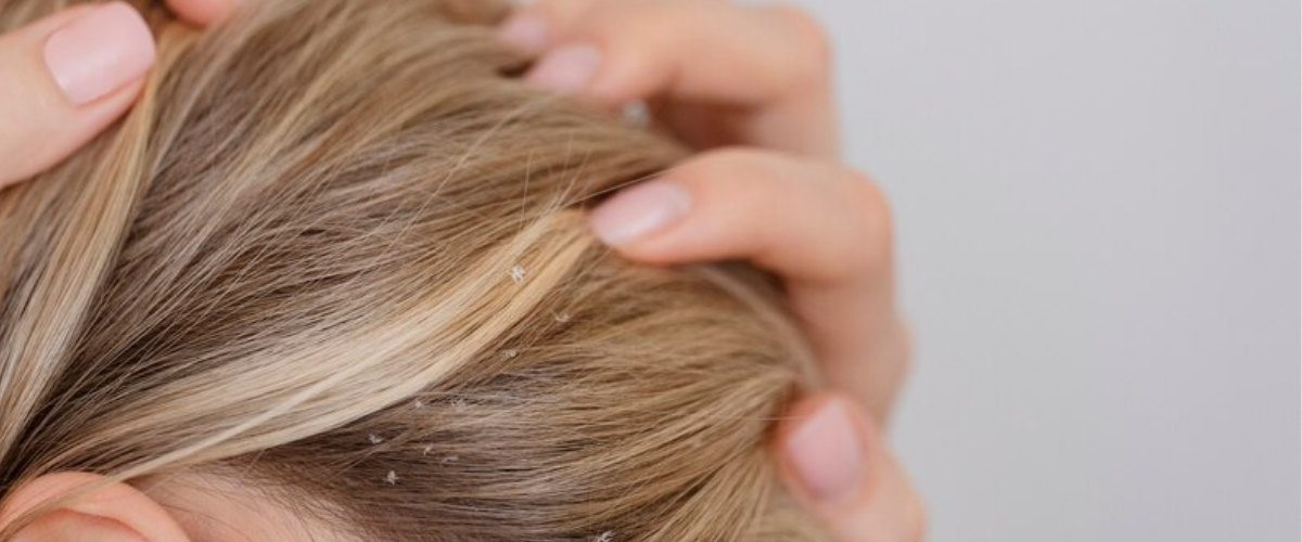 Read more about the article scalp psoriasis
