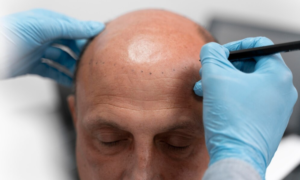 Read more about the article best hairline transplant